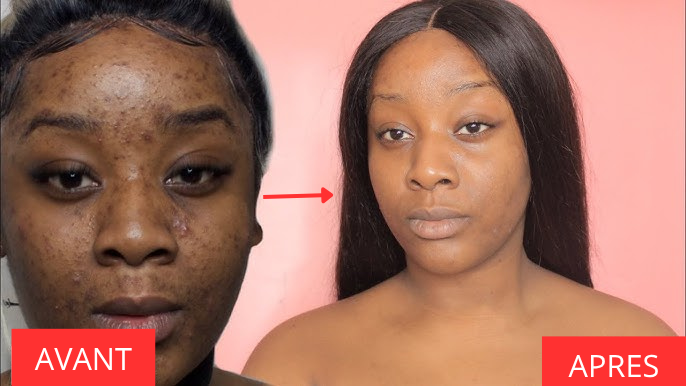 Crème Visage Kojic : Soin Complet Anti-Taches, Acné et Signes de l’Âge