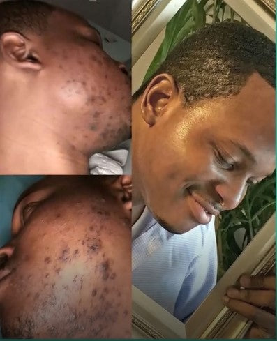 Crème Visage Kojic : Soin Complet Anti-Taches, Acné et Signes de l’Âge