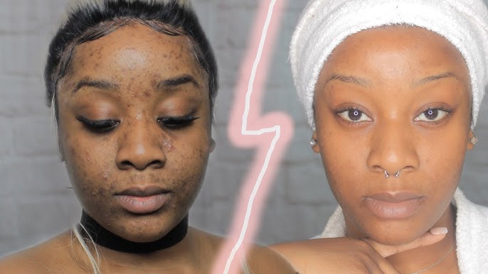 Crème Visage Kojic : Soin Complet Anti-Taches, Acné et Signes de l’Âge